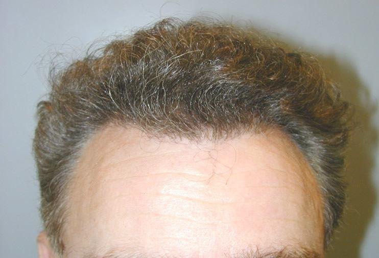 Golden Triangle Facial Plastic Surgery after — San Diego, CA