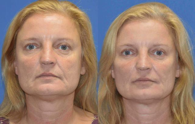 Dermal Fillers result at Golden Triangle Facial Plastic Surgery in San Diego, CA