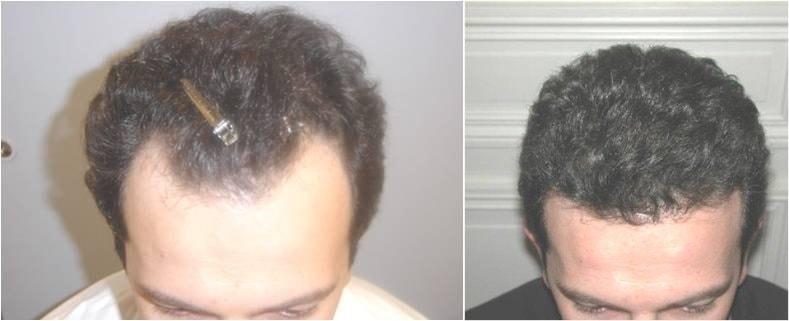 Golden Triangle Facial Plastic Surgery hair restoration result — San Diego, CA