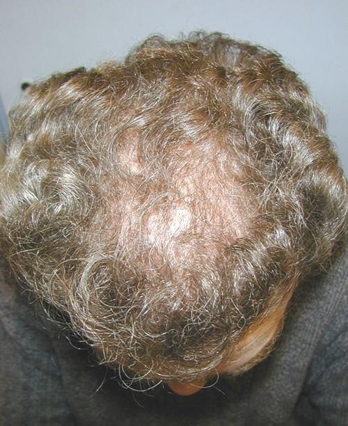Golden Triangle Facial Plastic Surgery after — San Diego, CA