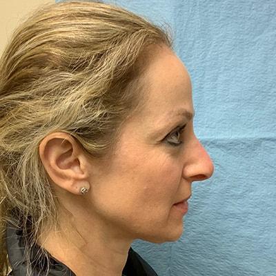 KH Plastic Surgery (Ari Hoschander, MD) liquid rhinoplasty after — Rockville Centre, NY