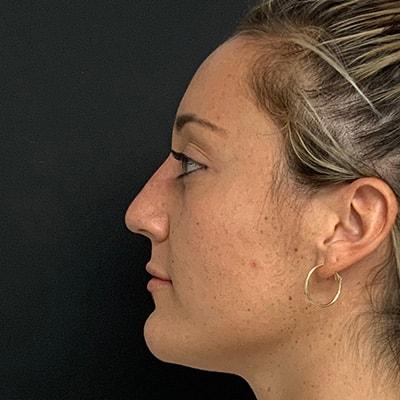 KH Plastic Surgery (Ari Hoschander, MD) liquid rhinoplasty after — Rockville Centre, NY