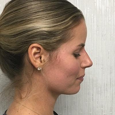 KH Plastic Surgery (Ari Hoschander, MD) liquid rhinoplasty after — Rockville Centre, NY