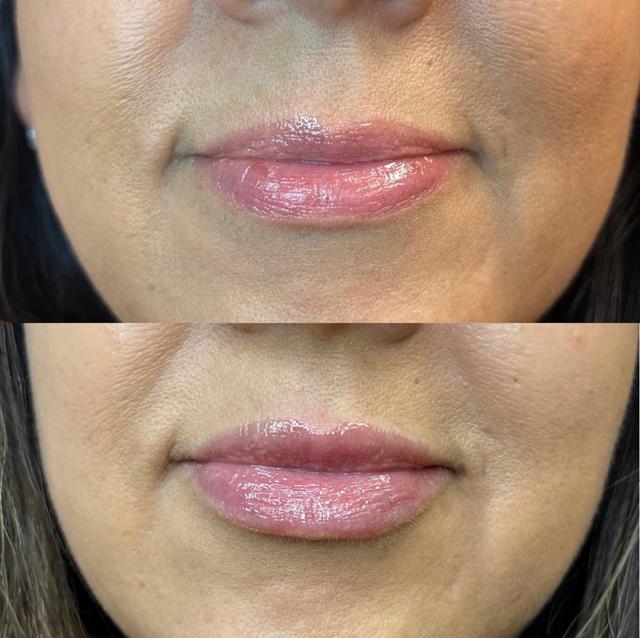 Lip Filler result at Amara Med Spa in St. George, UT