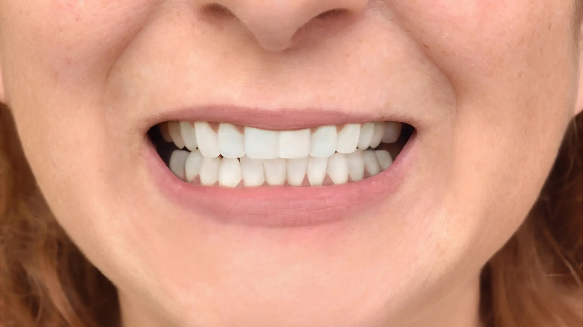 Smile Makers Family and Cosmetic Dentistry: Dr. Caitlin Flosi, DDS smile makeover after — Fort Worth, TX