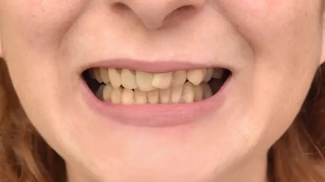 Smile Makeover before at Smile Makers Family and Cosmetic Dentistry: Dr. Caitlin Flosi, DDS in Fort Worth, TX