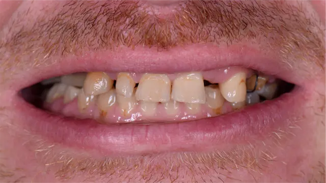 Smile Makeover before at Smile Makers Family and Cosmetic Dentistry: Dr. Caitlin Flosi, DDS in Fort Worth, TX