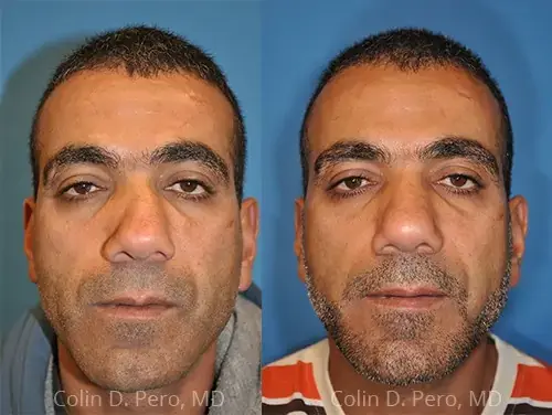 Revision Rhinoplasty result at Dr. Colin D. Pero, MD in Plano, TX