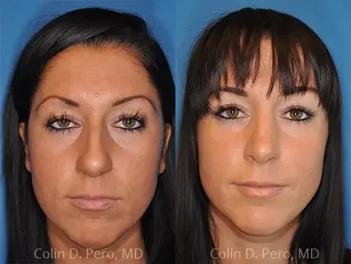 Revision Rhinoplasty result at Dr. Colin D. Pero, MD in Plano, TX