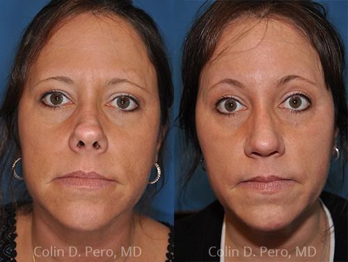 Revision Rhinoplasty result at Dr. Colin D. Pero, MD in Plano, TX