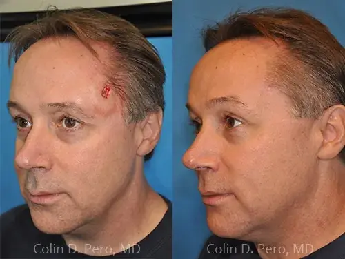 Facelift result at Dr. Colin D. Pero, MD in Plano, TX