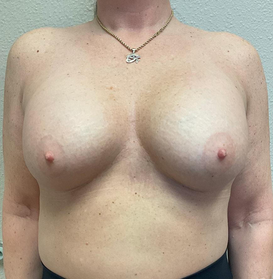 Foothills Plastic Surgery (Amie Miller, MD) breast augmentation after — El Dorado Hills, CA