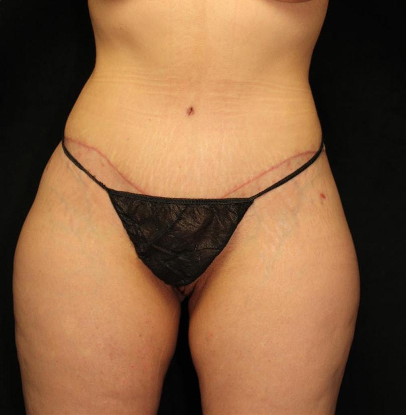 Foothills Plastic Surgery (Amie Miller, MD) tummy tuck after — El Dorado Hills, CA