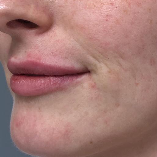 Lip Filler after at New Orleans Aesthetics in New Orleans, LA