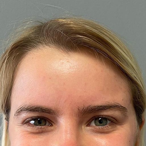 Botox before at New Orleans Aesthetics in New Orleans, LA