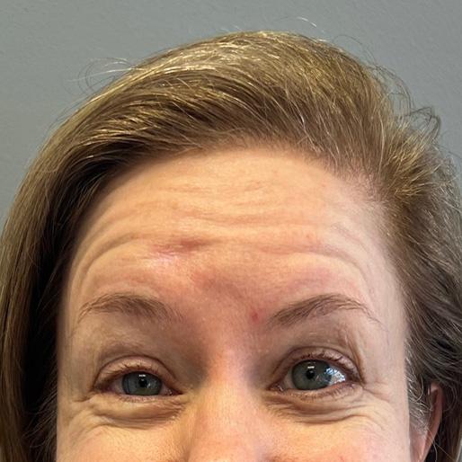 Botox before at New Orleans Aesthetics in New Orleans, LA
