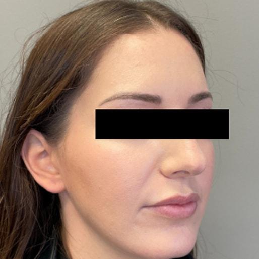 New Orleans Aesthetics lip filler after — New Orleans, LA