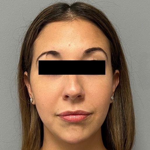 New Orleans Aesthetics lip filler after — New Orleans, LA