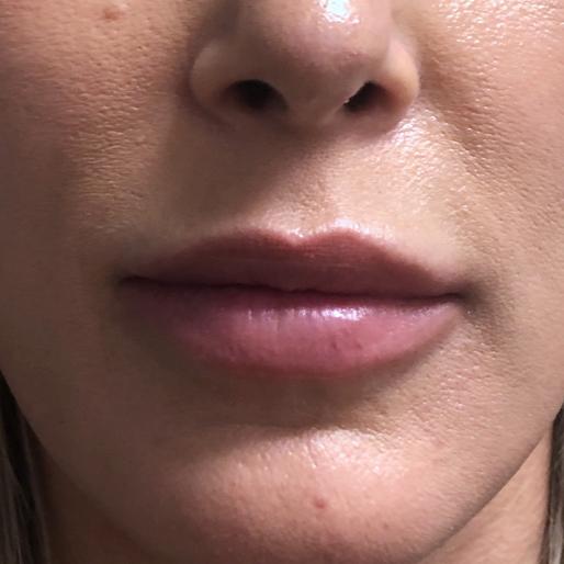 New Orleans Aesthetics lip filler after — New Orleans, LA