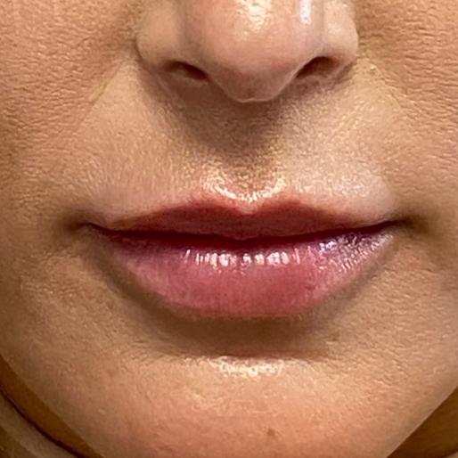 Dermal Fillers before at New Orleans Aesthetics in New Orleans, LA