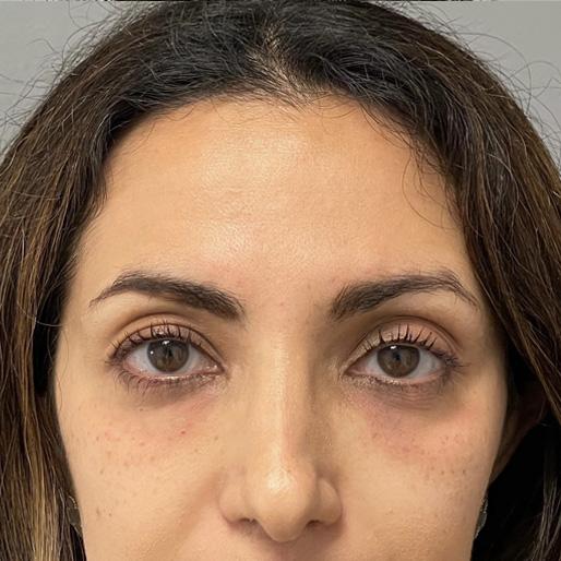 Dermal Fillers after at New Orleans Aesthetics in New Orleans, LA