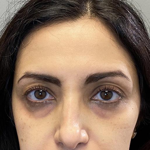 Dermal Fillers before at New Orleans Aesthetics in New Orleans, LA
