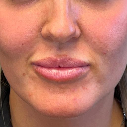 Dermal Fillers after at New Orleans Aesthetics in New Orleans, LA