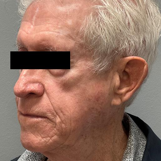 Deep Plane Facelift before at New Orleans Aesthetics in New Orleans, LA