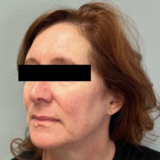 New Orleans Aesthetics facelift after — New Orleans, LA