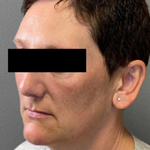 New Orleans Aesthetics facelift after — New Orleans, LA