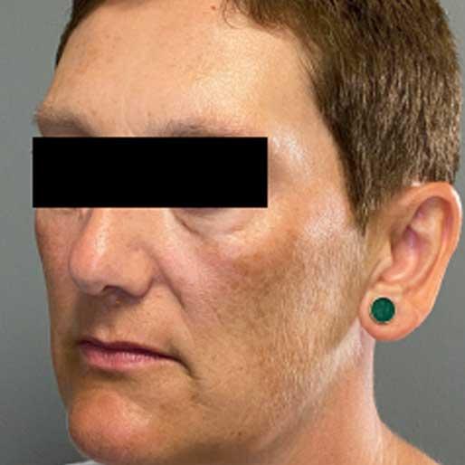 Deep Plane Facelift before at New Orleans Aesthetics in New Orleans, LA