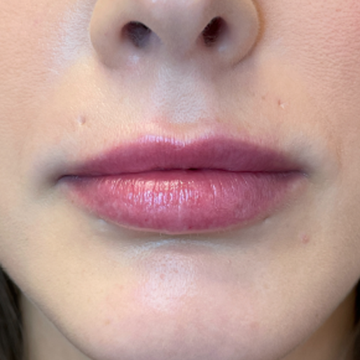 Dermal Fillers after at New Orleans Aesthetics in New Orleans, LA