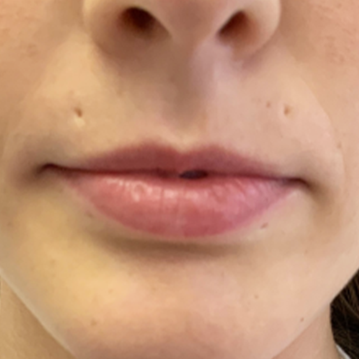 Dermal Fillers before at New Orleans Aesthetics in New Orleans, LA