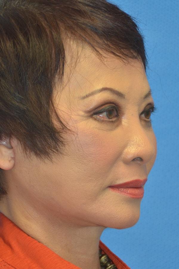 Union Square Facial Plastic Surgery (Lynn Chiu-Collins, MD) facelift after — San Francisco, CA