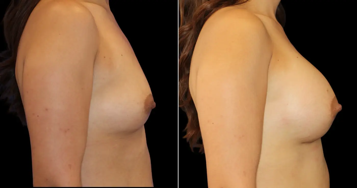 Hakimi Plastic Surgery laser treatment result — Beverly Hills, CA