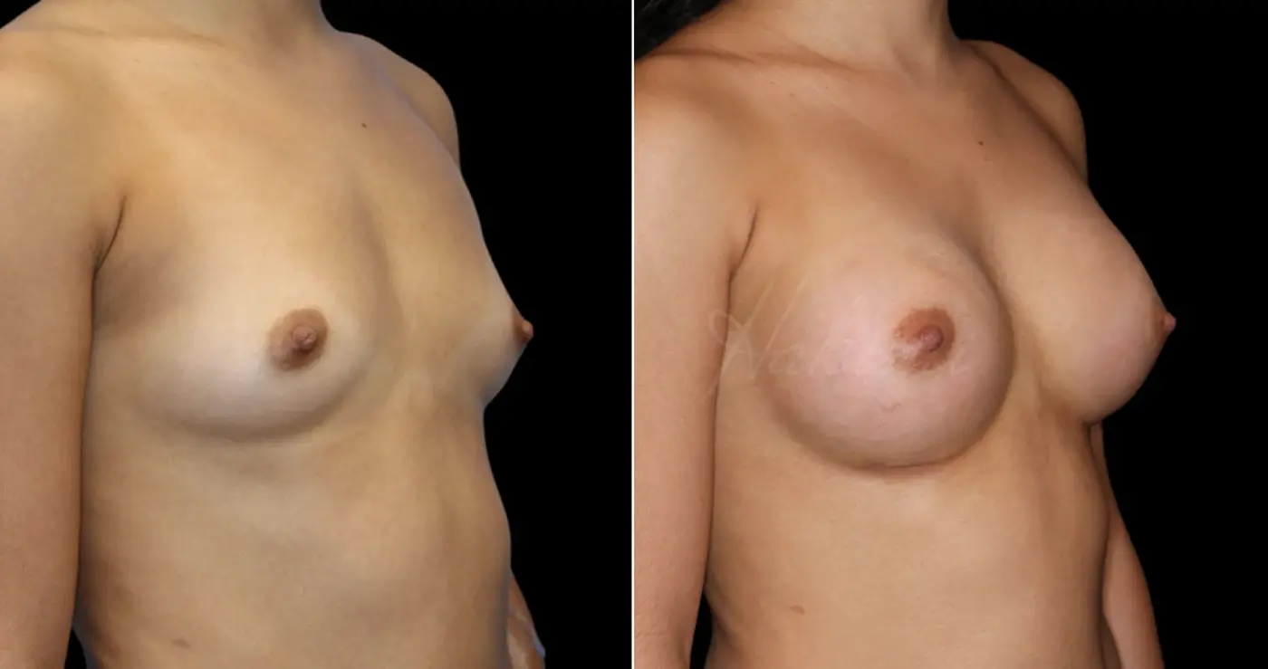 Hakimi Plastic Surgery breast augmentation result — Beverly Hills, CA