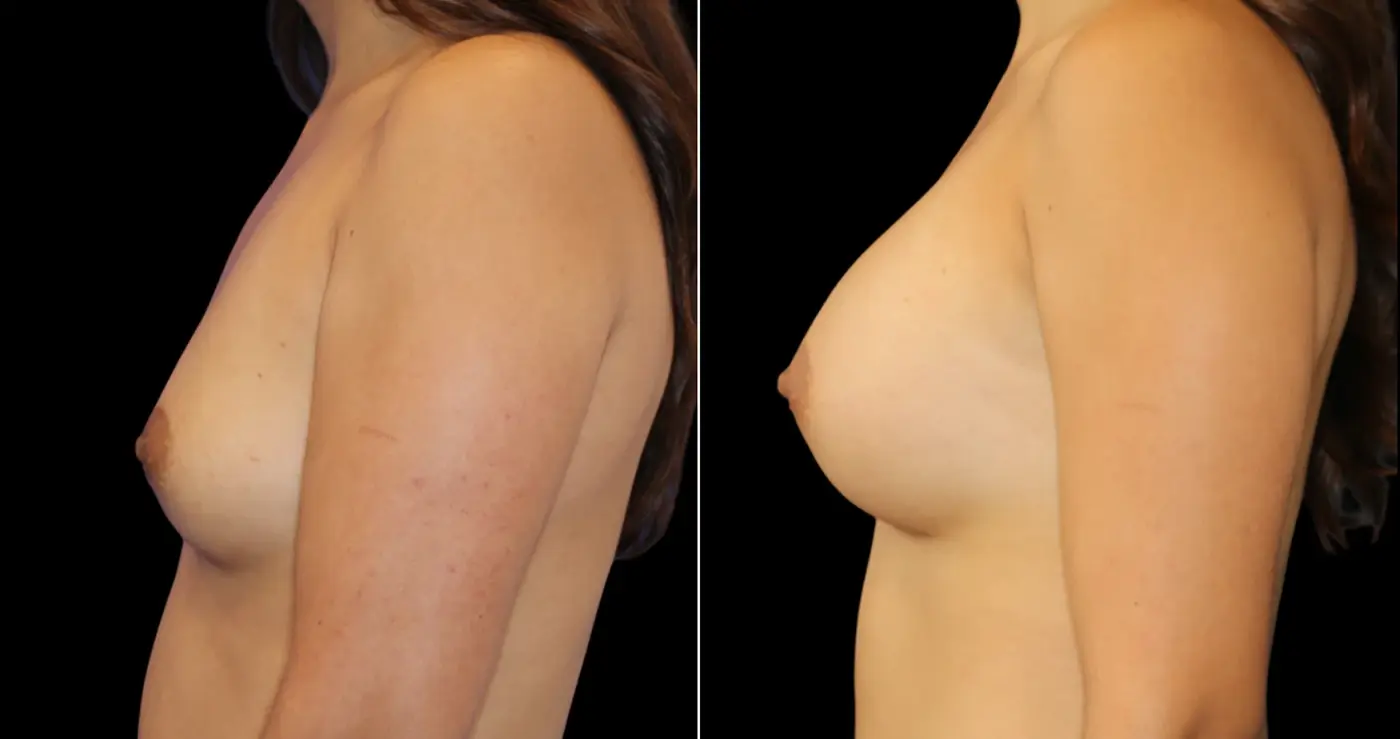 Hakimi Plastic Surgery laser treatment result — Beverly Hills, CA