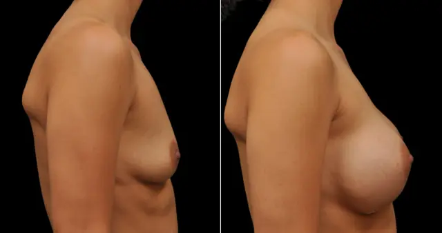 Laser Skin Resurfacing result at Hakimi Plastic Surgery in Beverly Hills, CA