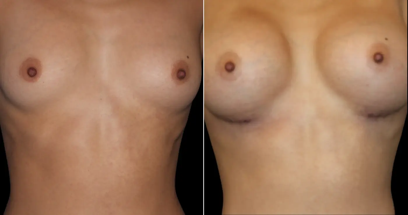 Hakimi Plastic Surgery breast augmentation result — Beverly Hills, CA