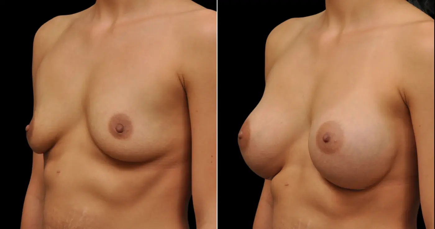 Hakimi Plastic Surgery laser treatment result — Beverly Hills, CA