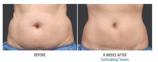 Thigh Lift result at Suddenly Slimmer Med Spa in Phoenix, AZ