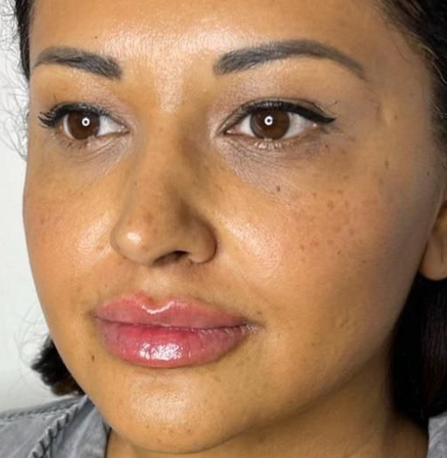 Dermal Fillers after at Suddenly Slimmer Med Spa in Phoenix, AZ
