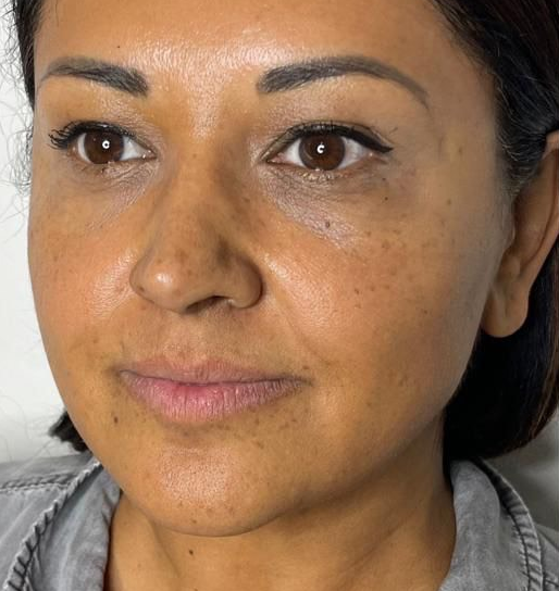 Dermal Fillers before at Suddenly Slimmer Med Spa in Phoenix, AZ