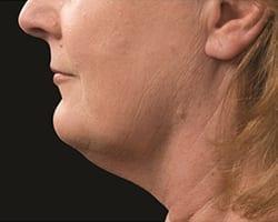 Suddenly Slimmer Med Spa after — Phoenix, AZ