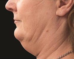 CoolSculpting before at Suddenly Slimmer Med Spa in Phoenix, AZ