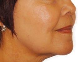 Suddenly Slimmer Med Spa after — Phoenix, AZ