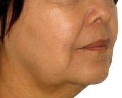 Deep Plane Facelift before at Suddenly Slimmer Med Spa in Phoenix, AZ