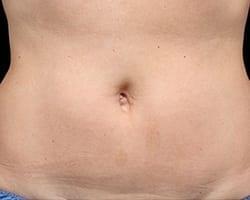 Suddenly Slimmer Med Spa after — Phoenix, AZ