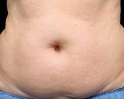 CoolSculpting before at Suddenly Slimmer Med Spa in Phoenix, AZ
