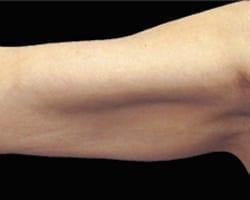 Suddenly Slimmer Med Spa after — Phoenix, AZ
